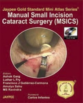 Manual Small incision Cataract Surgery (MSICS)