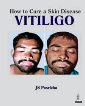 How to Cure a Skin Disease Vitiligo 