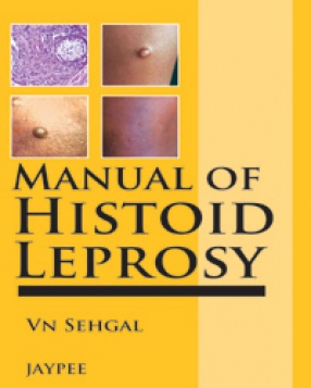 Manual of Histoid Leprosy 
