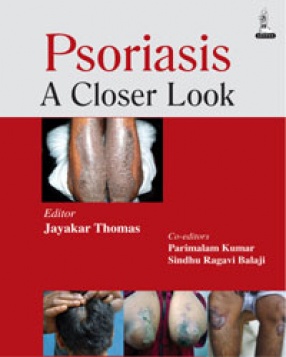 Psoriasis: A Closer Look 