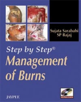 Step by Step Management of Burns