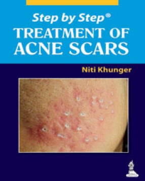 Step by Step Treatment of Acne Scars