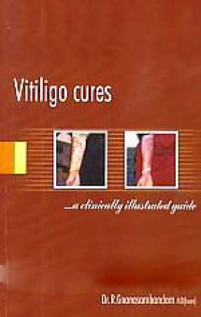 Vitiligo Cures: -A Clinically Illustrated Guide