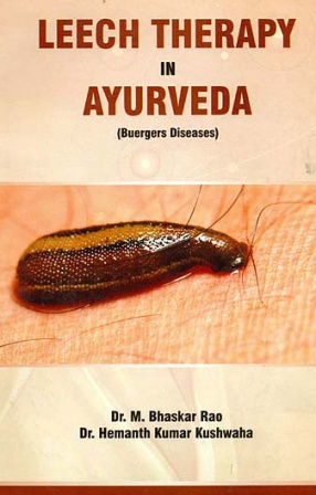 Leech Therapy in Ayurveda: Buergers Diseases