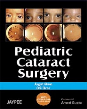 Pediatric Cataract Surgery