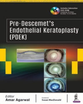 Pre-Descemet’s Endothelial Keratoplasty (PDEK)