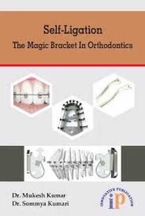 Self Ligation: the Magic Bracket in Orthodontics