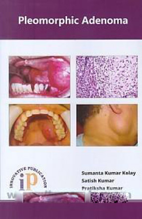 Pleomorphic Adenoma