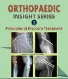 Principles of Fracture Treatment 