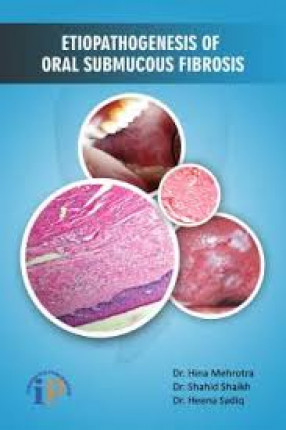 Etiopathogenesis of Oral Submucous Fibrosis