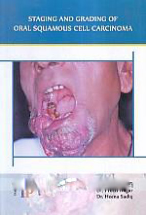 Staging and Grading of Oral Squamous Cell Carcinoma